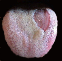 Kvasinky na jazyku