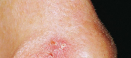 Rakovina kůže na nose