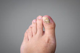 Nemoci nehtů na nohou