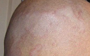Seboroická dermatitida - léčba