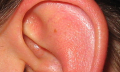 Co znamená pálení uší nebo pálení v uchu?