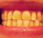 Žluté zuby