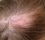 Rakovina kůže ve vlasech