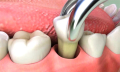 Bolest dásně po vytržení zubu